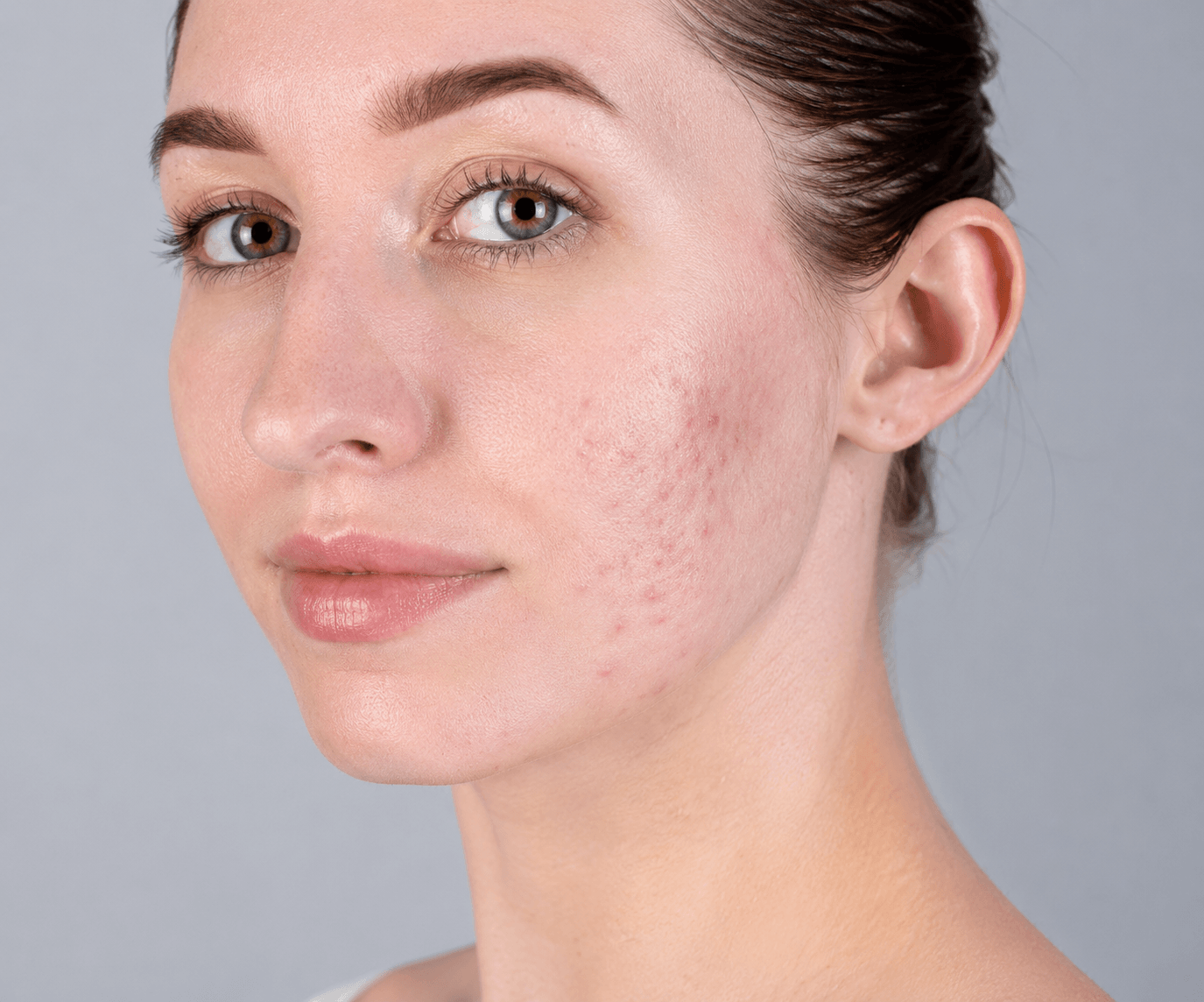 Before Daxxify treatment